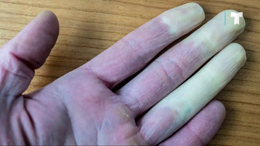 ¿Qué es la enfermedad de Raynaud?
