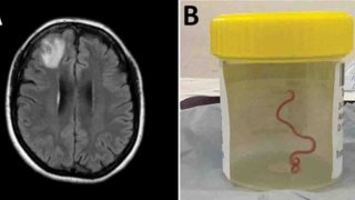 Un grupo de neurocirujanos extrajeron del cerebro de una mujer australiana una lombriz intestinal viva de ocho centímetros, el primer caso de este tipo en humanos.