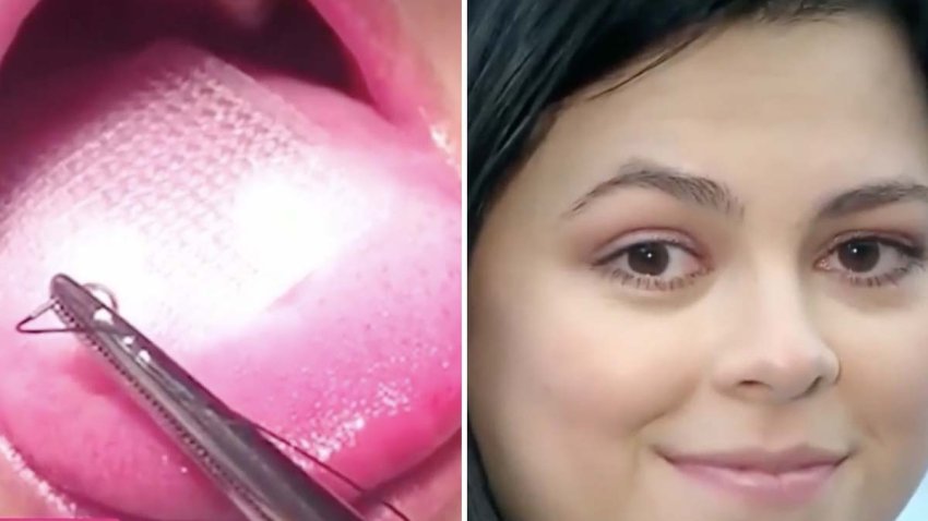 Actriz confiesa que se cosió la lengua para bajar de peso. Las secuelas que puede dejar