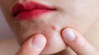 Inflamed acne consists of swelling, redness, and pores that are deeply clogged with bacteria, oil, and dead skin cells.