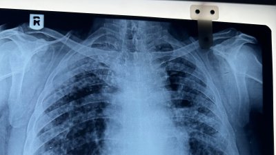 Aumentan los casos y muertes por silicosis en California: te explicamos de qué se trata esta terrible enfermedad